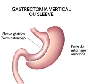 Cirurgia Bariátrica no Japão