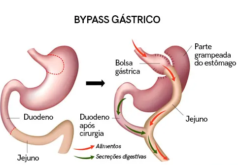 cirurgia-bariátrica-no-japão-by-pass